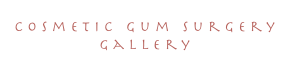 cosmetic gum surgery
Gallery