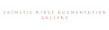 cosmetic ridge augmentation
Gallery